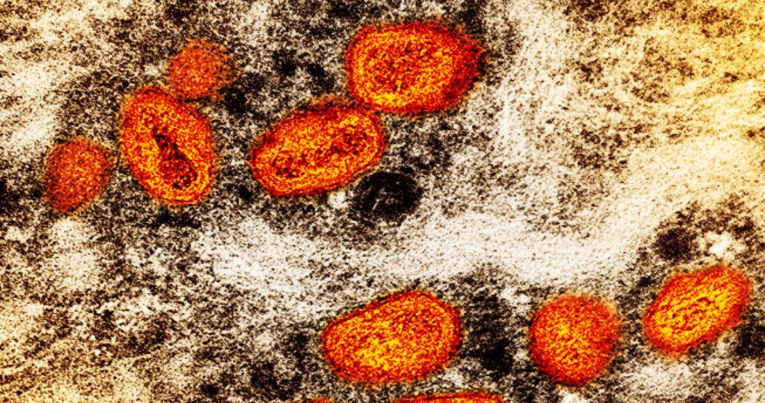 Esta Imagen Difundida Por El Instituto Nacional De Alergias Y Enfermedades Infecciosas De Eu Muestra Una Imagen a Color Captada Con Un Microscopio Electrónico De Barrido En El Que Se Ven Partículas De Viruela Símica En Anaranjado Encontradas Dentro De Una Célula Infectada marrón Cultivada En Un Laboratorio